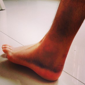 Ankle after my big Wiffle Ball injury!